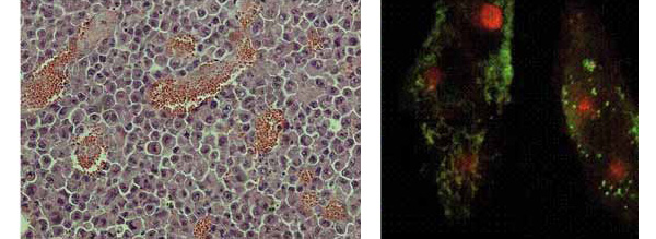 Рис. 4. Окрашивание обычными и флуоресцентными красителями. Слева — срез опухолевой ткани, окрашенной эозином и гематоксилином. Видны обширные поражения сосудов. Справа — клетки с проникшим в ядро противоопухолевым антибиотиком доксорубицином, который светится красным. (Предоставлено лабораторией химии липидов ИБХ РАН.) Изображение: «Химия и жизнь»