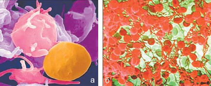 а — Тромбоциты — фрагменты крови, “заклеивающие” поврежденные сосуды. б — Фибриновый сгусток, состоящий из эритроцитов, тромбоцитов и нитей фибрина, образуется при заживлении раны. Изображение: «Наука и жизнь»