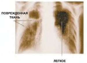 На рентгеновском снимке легких больного туберкулезом видны белые пятна на пораженных альвеолах - следствие плохого газообмена между легкими и кровью