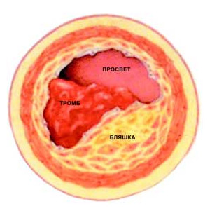Кровяные сгустки, тромбы, развиваются в области атеросклеротических бляшек, образующихся на внутренних стенках сосуда. Тромбы могут полностью перекрывать даже крупные сосуды, вызывая серьезные нарушения мозгового кровообращения. (Изображение: «Наука и жизнь»)