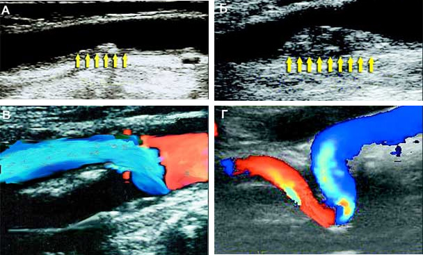 Дуплексное сканирование внутренней сонной артерии. Видна сформировавшаяся небольшая атеро-склеротическая бляшка, просвет сосуда немного сужен (А); более поздняя стадия атеросклероза - просвет сосуда внутренней сонной артерии частично перекрыт большой бляшкой (Б); окклюзия - полное закрытие просвета сосуда бляшкой (В); извитость артерии (Г) (Изображение: «Наука и жизнь»)