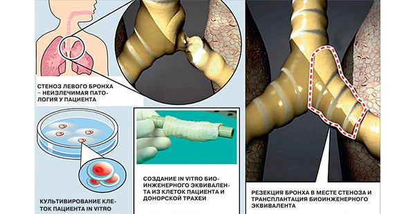 Схема первой в мире успешной трансплантации созданного in vitro биоинженерного эквивалента трахеи (2008 год, Маккиарини).