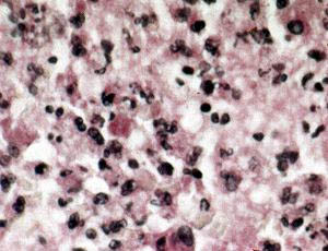 Легочная ткань, пораженная Rhodococcus equi