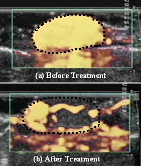 Изображения подкожной меланомы мыши, полученные ультразвуковым энергетическим доплеровским картированием, до и после воздействия мягким ультразвуком. Светлые участки соответствуют контрастному веществу, которое перед исследованием было введено в ток крови. Видно, что после воздействия большая часть опухоли лишилась кровоснабжения. В то же время доступ крови в окружающие нормальные ткани сохранился (изображение с сайта www.uphs.upenn.edu)