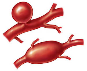 Характерные виды аневризм — расширений сосудов из-за патологического изменения их стенок, — которые могут стать следствием болезни Кавасаки (рис. с сайта neuro.wehealny.org)