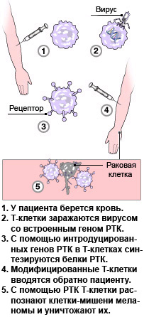 Схема терапии Стивена Розенберга (изображение с сайта news.bbc.co.uk)