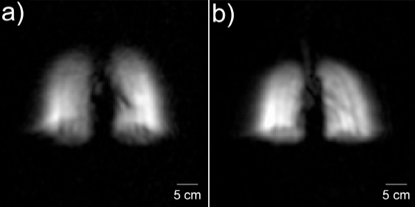 Изображение легких у горизонтально (a) и вертикально (b) расположенных пациентов (фото из обсуждаемой статьи)