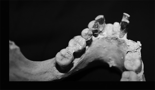 Нижняя челюсть, демонстрирующая типичные для палауанских карликов признаки: крупные зубы, «скученность» зубов в передней части, клыки похожи на резцы, премоляры — на клыки; третьи моляры («зубы мудрости») отсутствуют. Эти особенности могут быть следствием очень быстрого уменьшения размеров тела, причем зубы «не успели» уменьшиться в той же пропорции, что и другие части скелета. Фото из обсуждаемой статьи в PLoS ONE