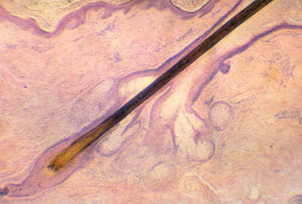 Микрофотография волосяного фолликула человека в продольном разрезе. Клетки волосяных фолликулов исследователи научились успешно перепрограммировать, получая из них аналоги эмбриональных стволовых клеток. На основе этой методики ученые надеются разработать методы лечения множества болезней. Единственного извлеченного с корнем волоса может быть достаточно, чтобы получить культуру клеток, способных многократно делиться и, при определенных условиях, дифференцироваться, образуя клетки различного типа, генетически идентичные исходным — или модифицированные определенным образом (в частности, из них можно удалить гены, работа которых вызывает некоторую болезнь, а затем внедрить их в организм на место пораженных болезнью тканей). Из статьи Гретхен Фогель (Gretchen Vogel) в журнале Science о главном научном прорыве 2008 года