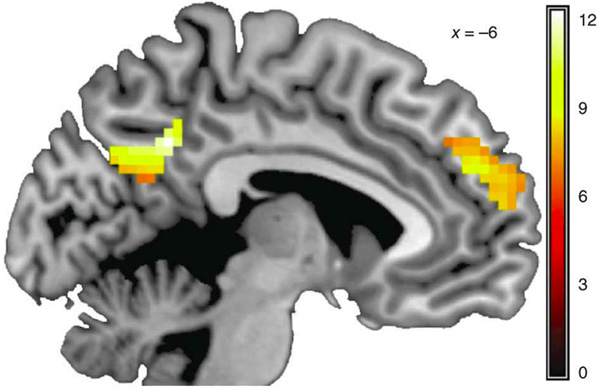 Чем сильнее активация дорсомедиальной части префронтальной коры (желто-оранжевое пятно справа) при предъявлении «целевых» сообщений, тем больше вероятность, что человеку удастся бросить курить. Активация предклинья (желто-оранжевое пятно слева) в меньшей степени связана со способностью избавиться от курения. Изображение из обсуждаемой статьи в Nature Neuroscience