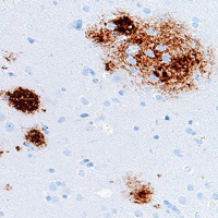 Сенильные бляшки бета-амилоида