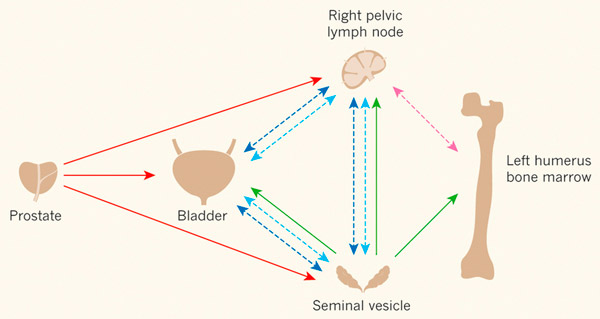 Рис. 3. Схема распространения метастаз при раке простаты
