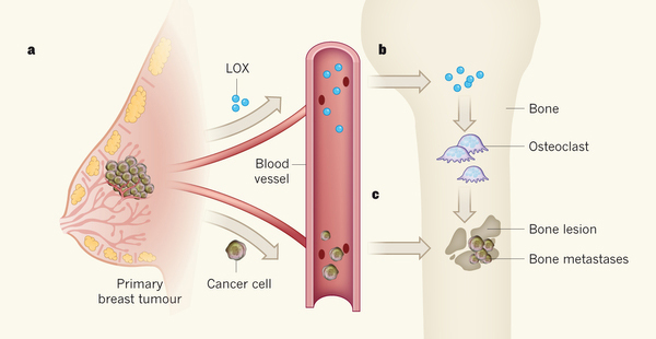 Создание в костях ниш для метастазов
