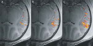Слуховая кора в действии (изображение создано с помощью ФМР-сканирования). Цветные точки отмечают области, степень активации которых резко повышается при воздействии определенного типа импульсов: a) при тактильной стимуляции руки, b) при звуковой стимуляции, c) при одновременной тактильной и звуковой стимуляции. Появление большего количества активных областей в третьем случае, чем во втором указывает на то, что тактильная стимуляция влияет на процесс обработки звукового сигнала (т. е. здесь имеет место мультисенсорная интеграция). Изображение с сайта www.mpg.de
