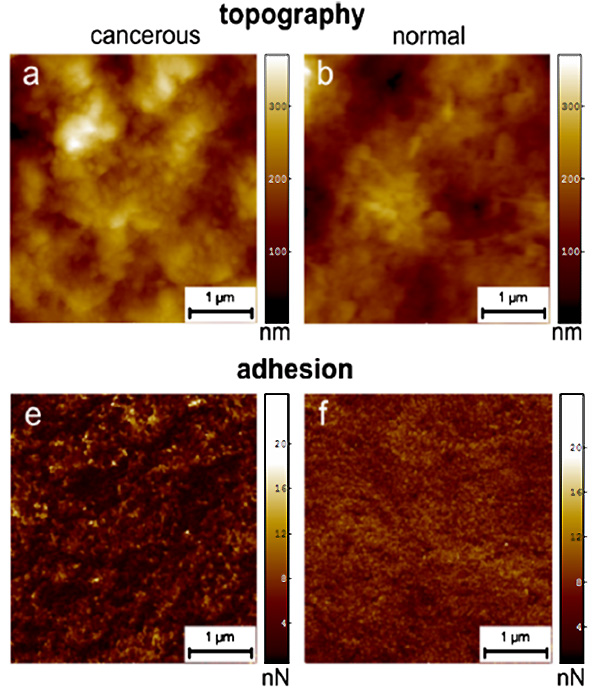 Рис. 1. (a), (b) Топография поверхности раковых (cancerous) и нормальных (normal) клеток, полученная при помощи атомно-силового микроскопа. (e), (f) Карта адгезии (adhesion — сцепление) поверхности нормальных и раковых клеток (визуализация данных по распределению силы адгезии иглы атомно-силового микроскопа с каждой точкой поверхности нормальных и раковых клеток). Рисунок из обсуждаемой статьи в Phys. Rev. Lett.