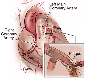 Коронарные артерии снабжают сердце насыщенной кислородом кровью. При блокировании их холестериновыми бляшками ткани сердечной мышцы погибают, что ведет к инфаркту. Рисунок с сайта heartonline.org