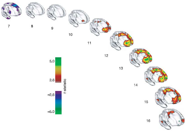 Различия по толщине разных участков коры между «очень умными» и «средними» индивидуумами в зависимости от возраста (возраст обозначен цифрами рядом со схематическими изображениями правого полушария). Фиолетовые и синие тона показывают участки, в которых у «средних» детей кора толще, чем у «очень умных»; красные, желтые и зеленые — участки, где более толстая кора характерна для «самых умных». Видно, что в раннем возрасте у «средних» детей во многих участках кора толще, затем начиная с 10-11 лет более толстая кора характерна для «очень умных» (особенно в лобных долях), эти различия достигают максимума к 13 годам и затем постепенно сходят на нет (рис. из статьи в Nature)