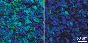Стволовые клетки среди прочих клеток в двух разных злокачественных глиомах