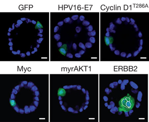 Из нескольких белков, участвующих в канцерогенезе, только ERBB2 вызывает развитие опухоли из одной клетки в 3D-культурах