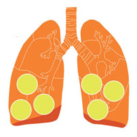 Когда пневмония закончится